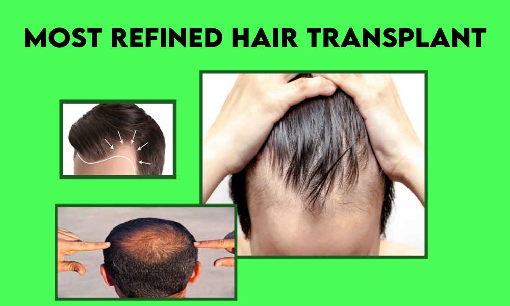 Keys to Most Refined Hair Transplant